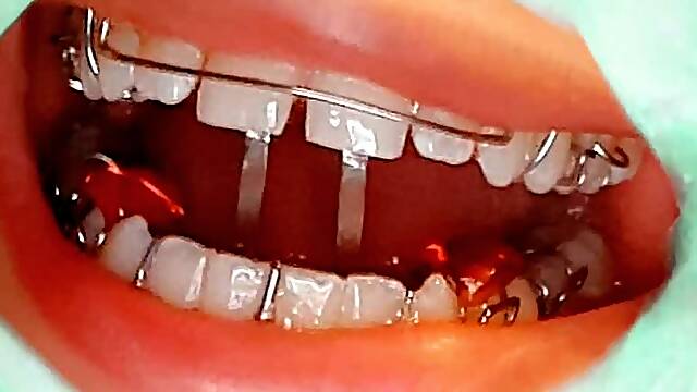 GlitterGiiiirl´s Braces Up Close: Loose Retainer in My Mouth Intimate Close-Up Views with wig